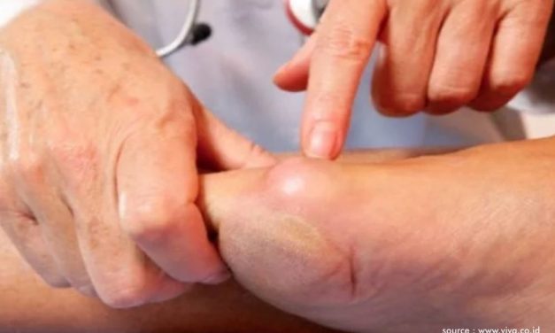 Millenials Wajib Mengetahui Khasiat Obat Asam Urat MOSEHAT